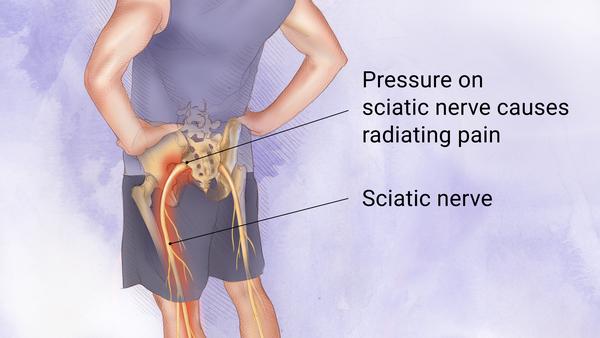 Sciatica treatment and advice by a chiropractor
